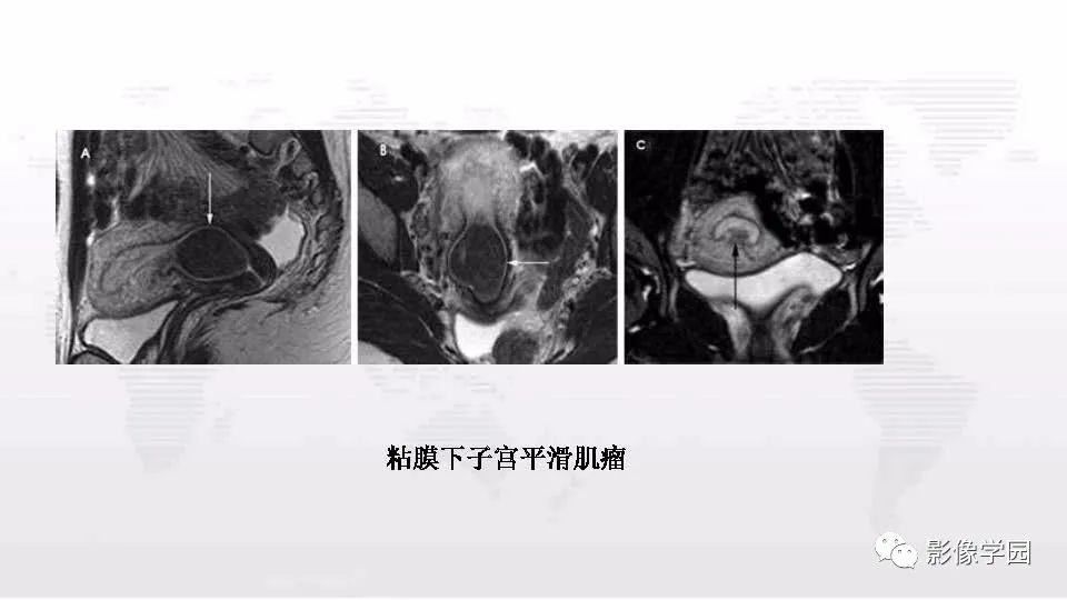 影像PPT - 【PPT】子宫内膜癌MR诊断与鉴别-67
