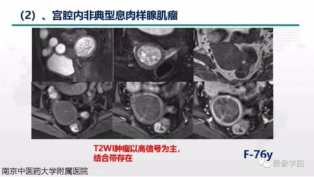影像PPT - 【PPT】子宫内膜癌MR诊断与鉴别-68