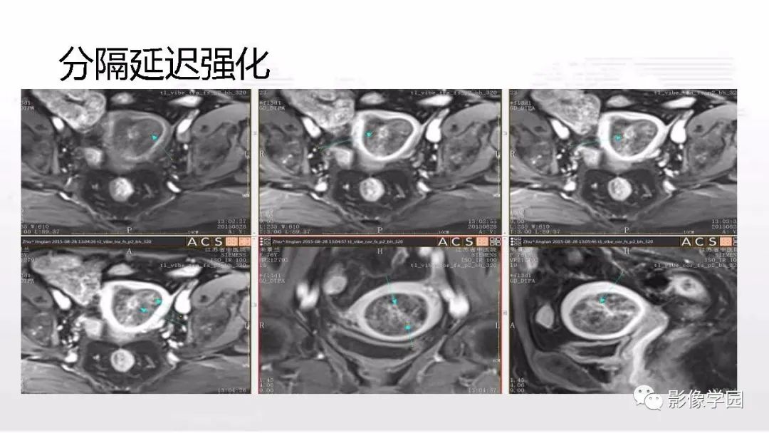 影像PPT - 【PPT】子宫内膜癌MR诊断与鉴别-71
