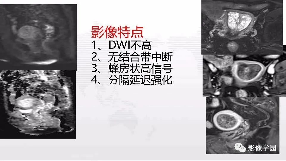 影像PPT - 【PPT】子宫内膜癌MR诊断与鉴别-72