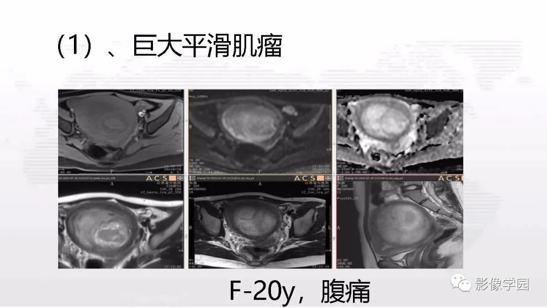 影像PPT - 【PPT】子宫内膜癌MR诊断与鉴别-75