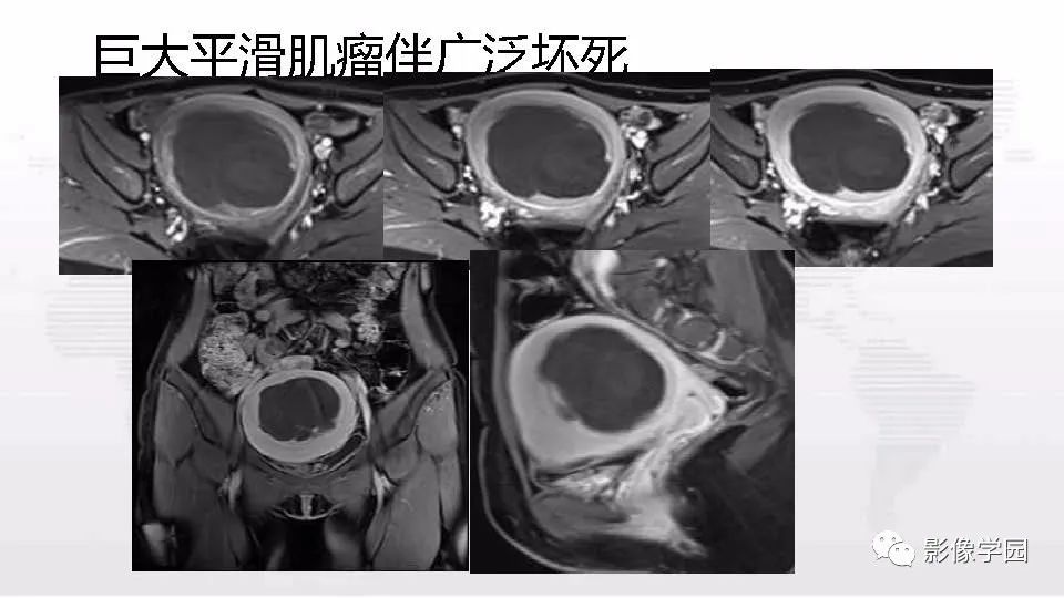 影像PPT - 【PPT】子宫内膜癌MR诊断与鉴别-76
