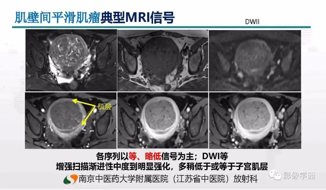 影像PPT - 【PPT】子宫内膜癌MR诊断与鉴别-78