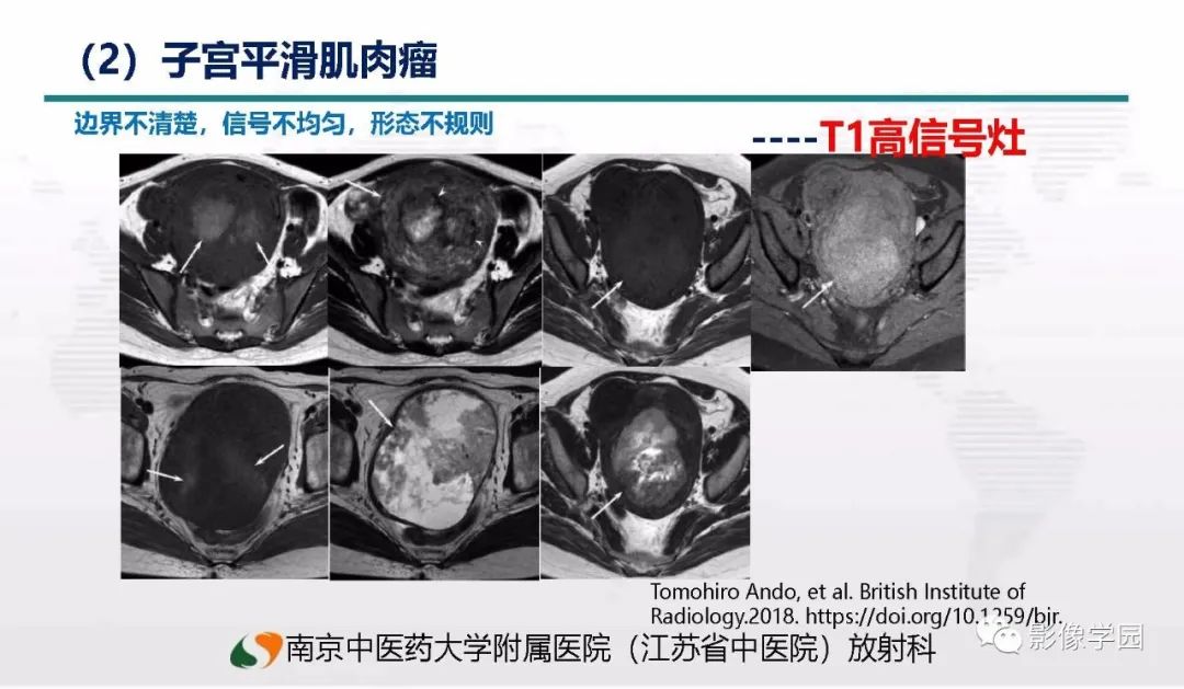 影像PPT - 【PPT】子宫内膜癌MR诊断与鉴别-79