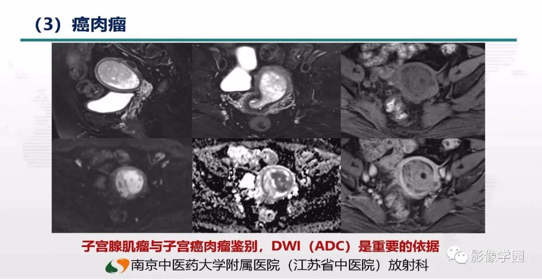 影像PPT - 【PPT】子宫内膜癌MR诊断与鉴别-80