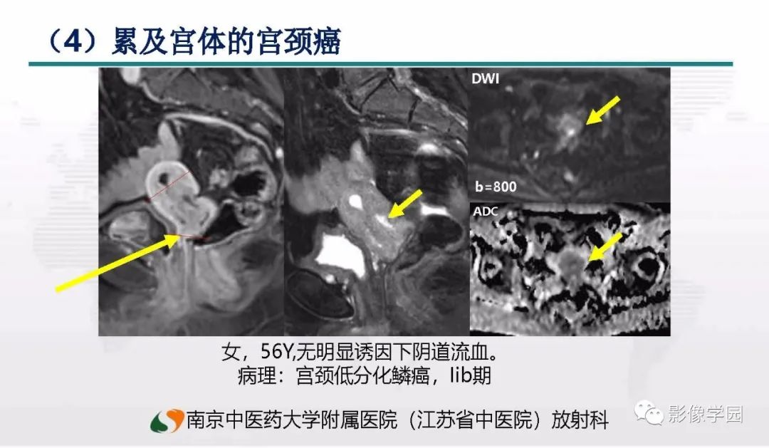 影像PPT - 【PPT】子宫内膜癌MR诊断与鉴别-81