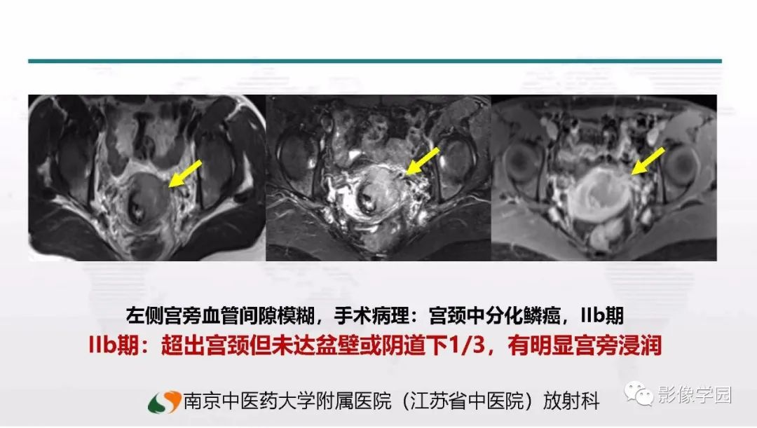 影像PPT - 【PPT】子宫内膜癌MR诊断与鉴别-82