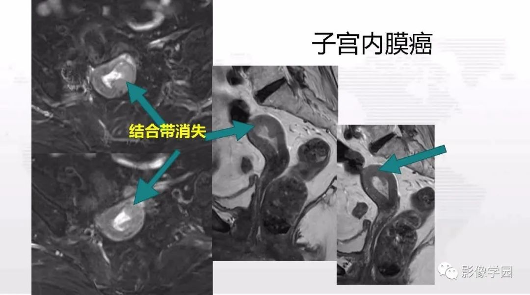 影像PPT - 【PPT】子宫内膜癌MR诊断与鉴别-88