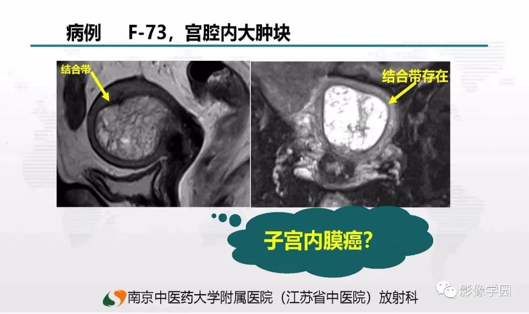 影像PPT - 【PPT】子宫内膜癌MR诊断与鉴别-89