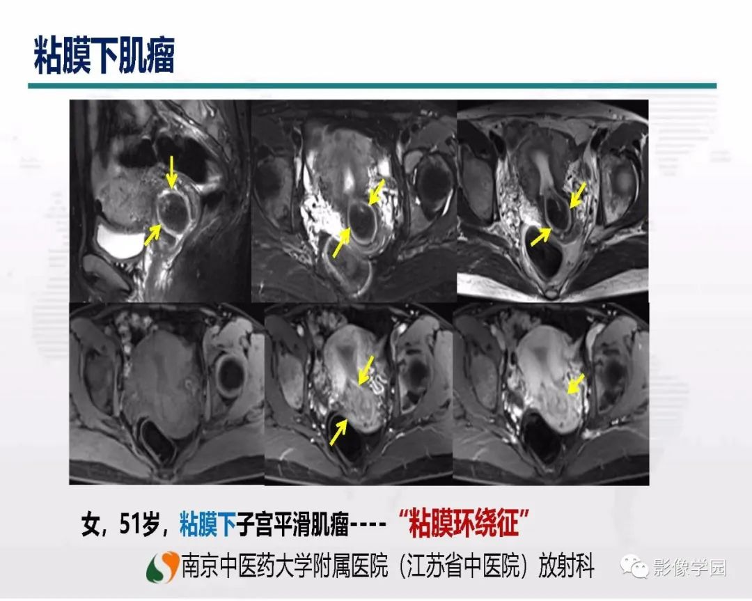 影像PPT - 【PPT】子宫内膜癌MR诊断与鉴别-90
