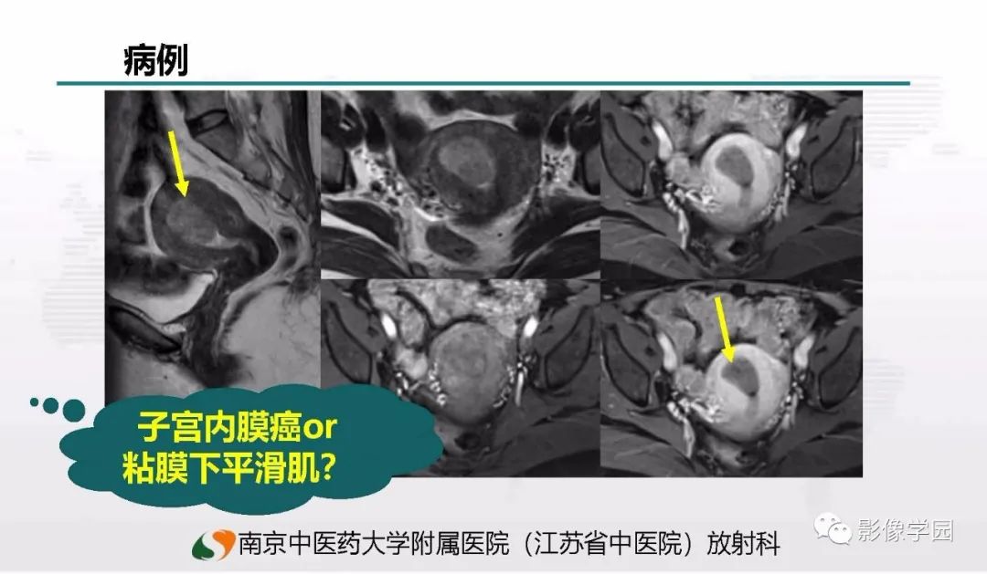 影像PPT - 【PPT】子宫内膜癌MR诊断与鉴别-92