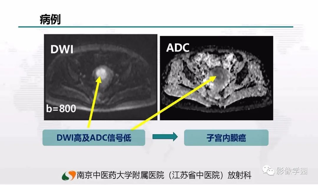 影像PPT - 【PPT】子宫内膜癌MR诊断与鉴别-93