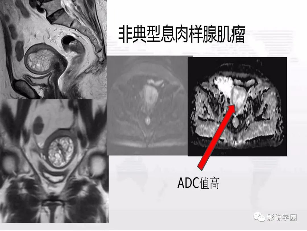 影像PPT - 【PPT】子宫内膜癌MR诊断与鉴别-94