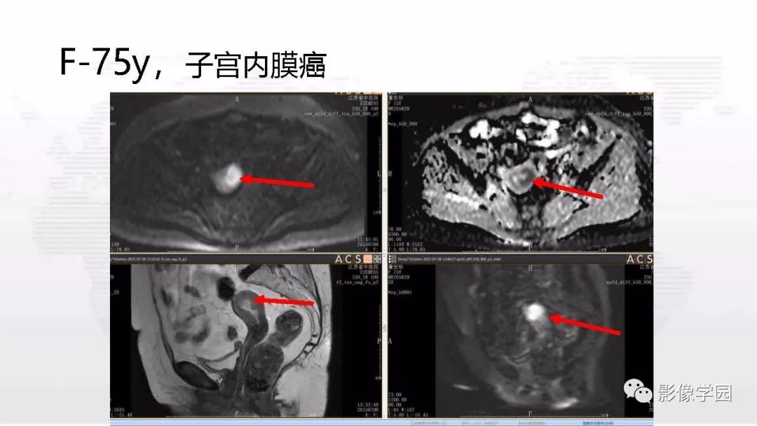 影像PPT - 【PPT】子宫内膜癌MR诊断与鉴别-95