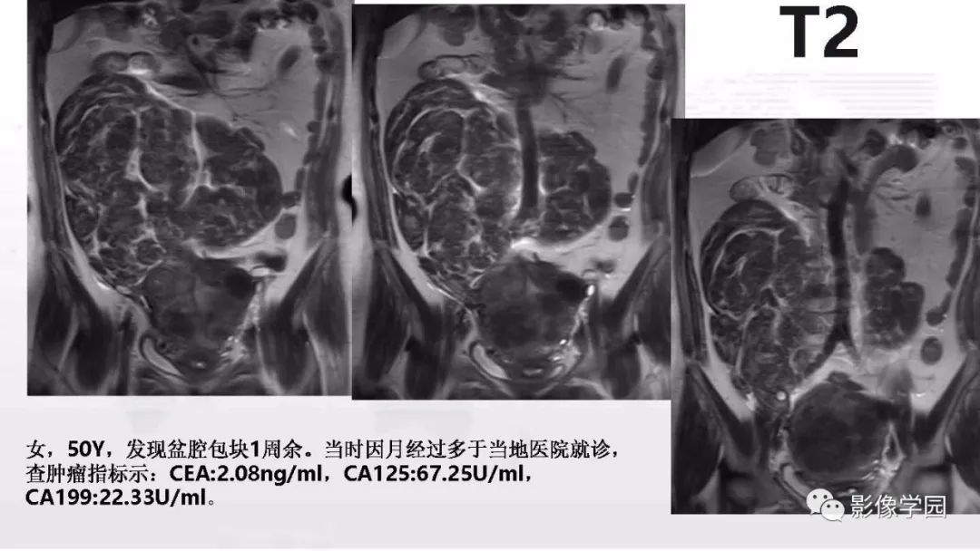 影像PPT - 【PPT】子宫内膜癌MR诊断与鉴别-96