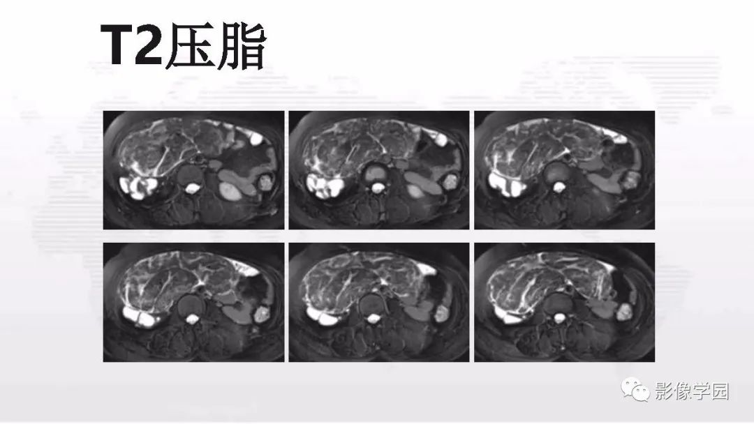 影像PPT - 【PPT】子宫内膜癌MR诊断与鉴别-98
