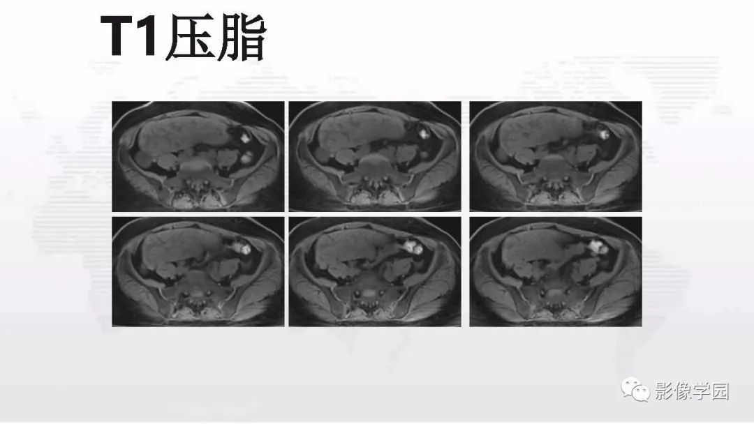 影像PPT - 【PPT】子宫内膜癌MR诊断与鉴别-99