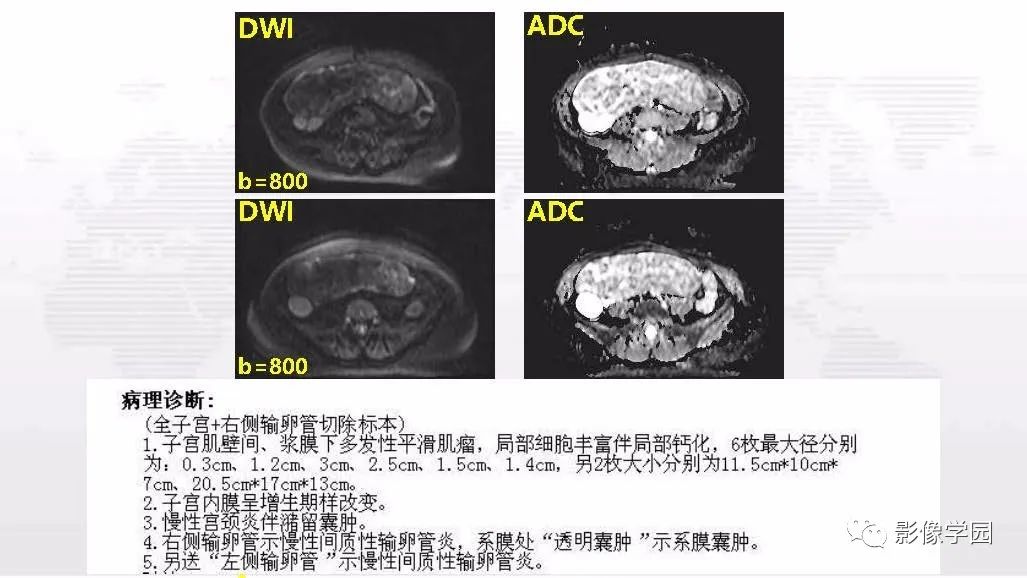 影像PPT - 【PPT】子宫内膜癌MR诊断与鉴别-100