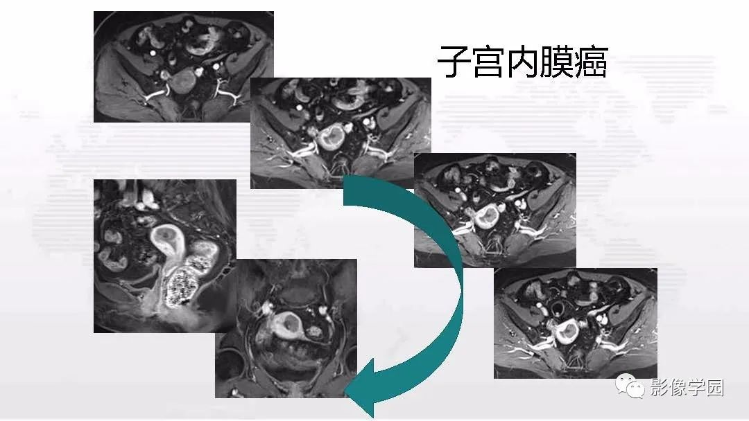 影像PPT - 【PPT】子宫内膜癌MR诊断与鉴别-102