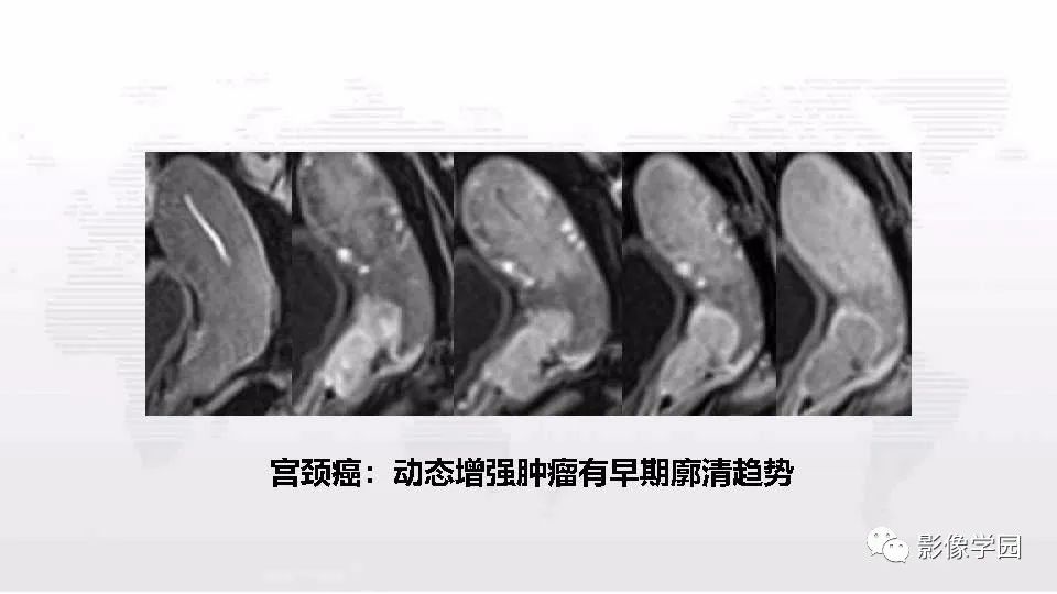 影像PPT - 【PPT】子宫内膜癌MR诊断与鉴别-103