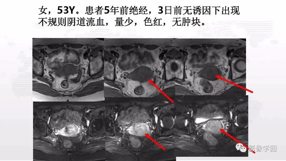 影像PPT - 【PPT】子宫内膜癌MR诊断与鉴别-104