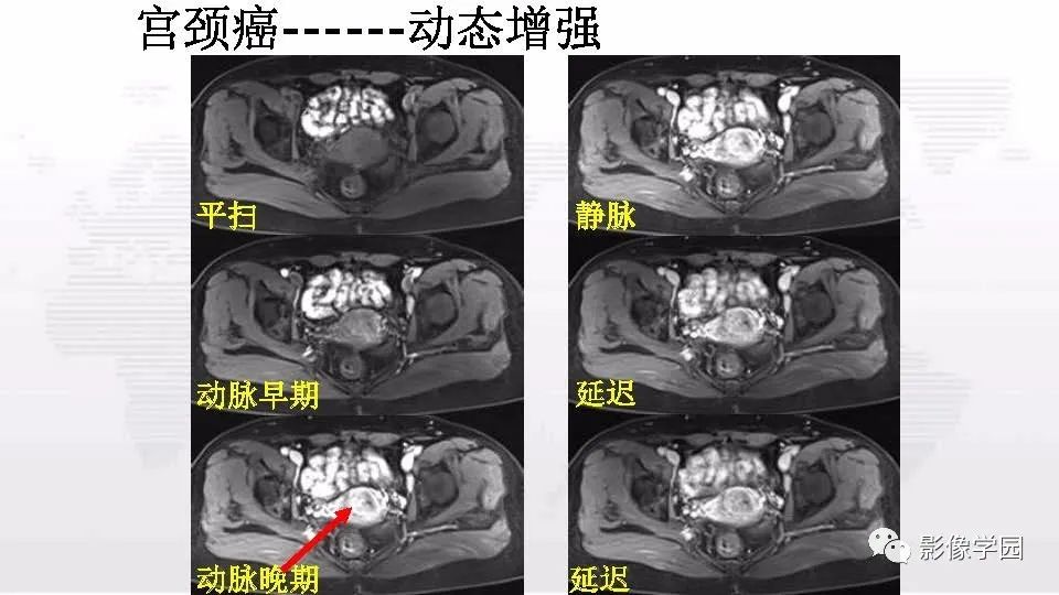 影像PPT - 【PPT】子宫内膜癌MR诊断与鉴别-105