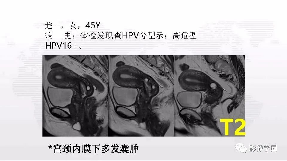 影像PPT - 【PPT】子宫内膜癌MR诊断与鉴别-106