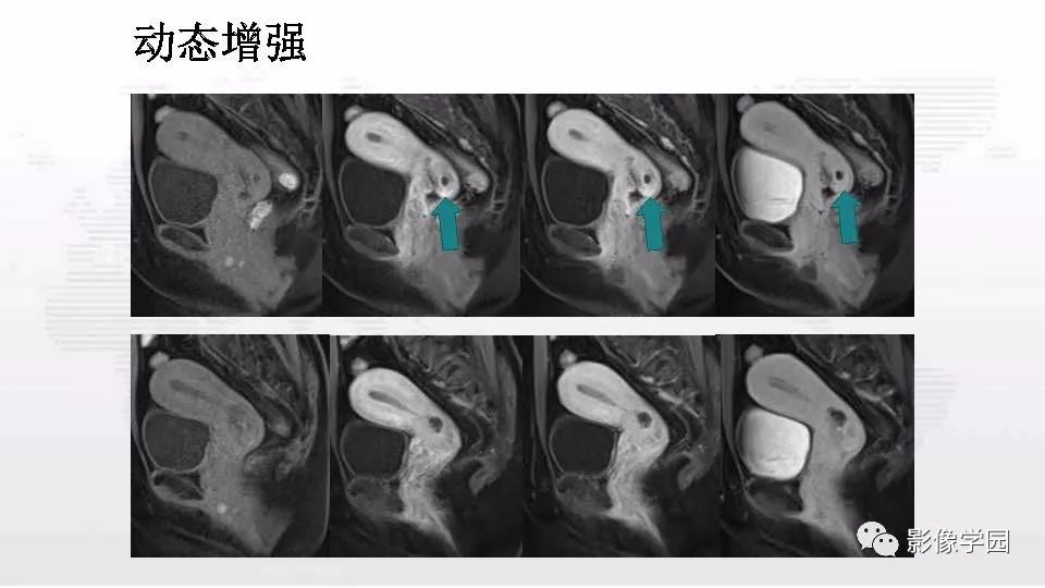 影像PPT - 【PPT】子宫内膜癌MR诊断与鉴别-107