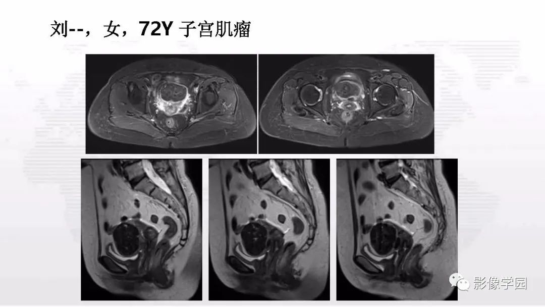 影像PPT - 【PPT】子宫内膜癌MR诊断与鉴别-109
