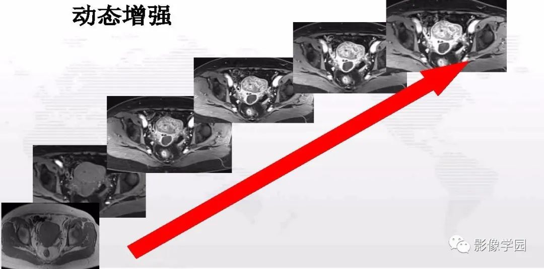 影像PPT - 【PPT】子宫内膜癌MR诊断与鉴别-110