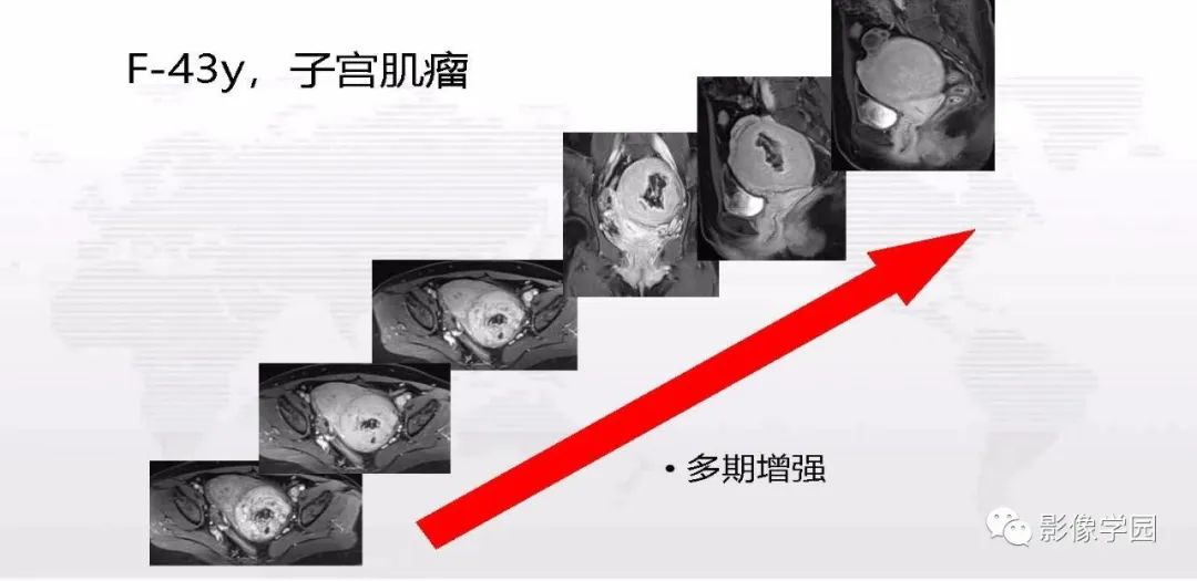 影像PPT - 【PPT】子宫内膜癌MR诊断与鉴别-111
