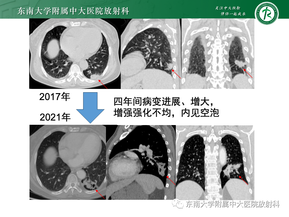 影像PPT - 【PPT】肺炎型黏液腺癌的CT表现-5