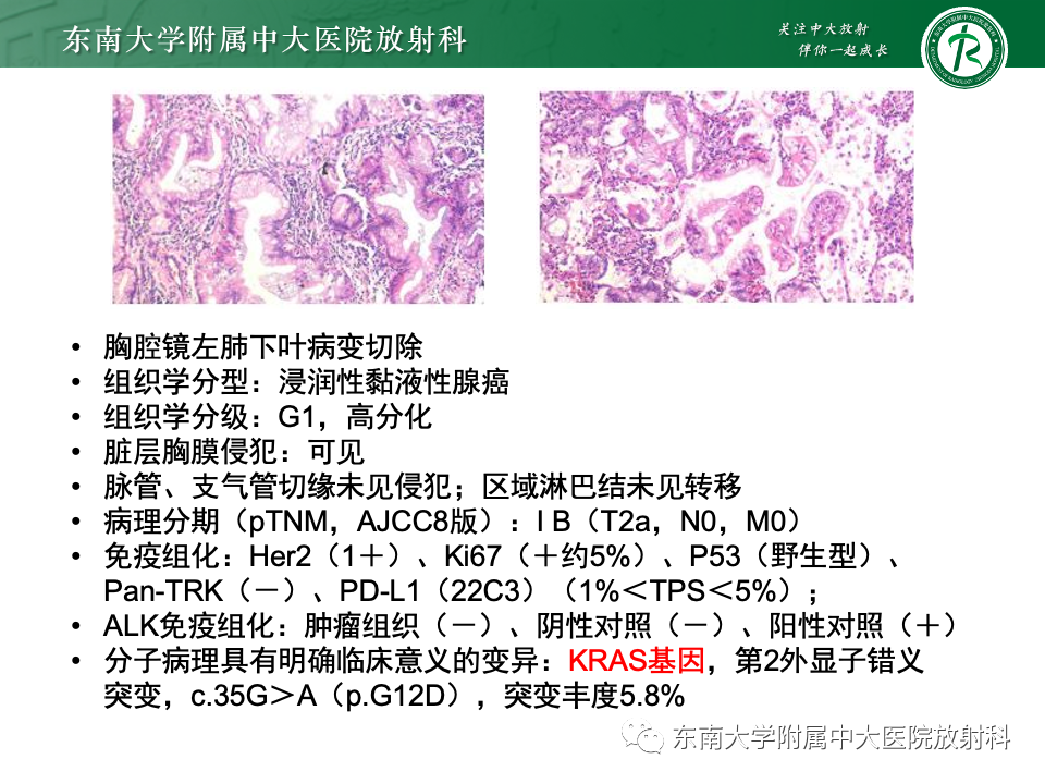 影像PPT - 【PPT】肺炎型黏液腺癌的CT表现-6