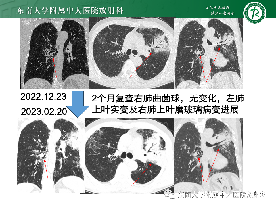 影像PPT - 【PPT】肺炎型黏液腺癌的CT表现-14