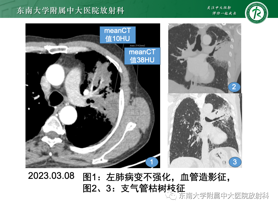 影像PPT - 【PPT】肺炎型黏液腺癌的CT表现-15
