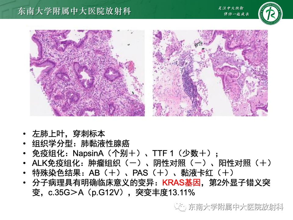 影像PPT - 【PPT】肺炎型黏液腺癌的CT表现-16