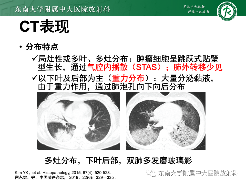 影像PPT - 【PPT】肺炎型黏液腺癌的CT表现-17