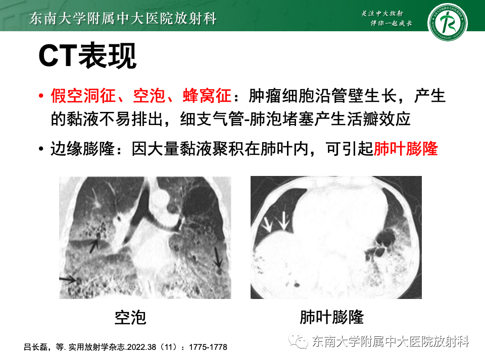 影像PPT - 【PPT】肺炎型黏液腺癌的CT表现-18