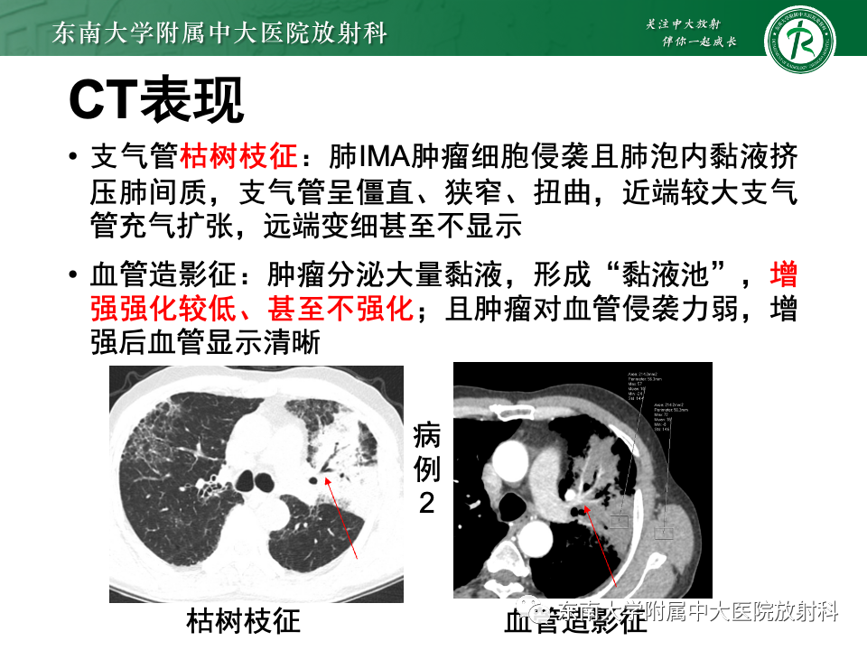 影像PPT - 【PPT】肺炎型黏液腺癌的CT表现-19