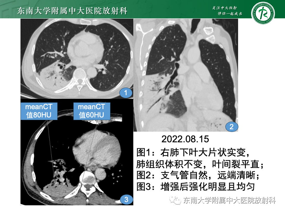 影像PPT - 【PPT】肺炎型黏液腺癌的CT表现-22
