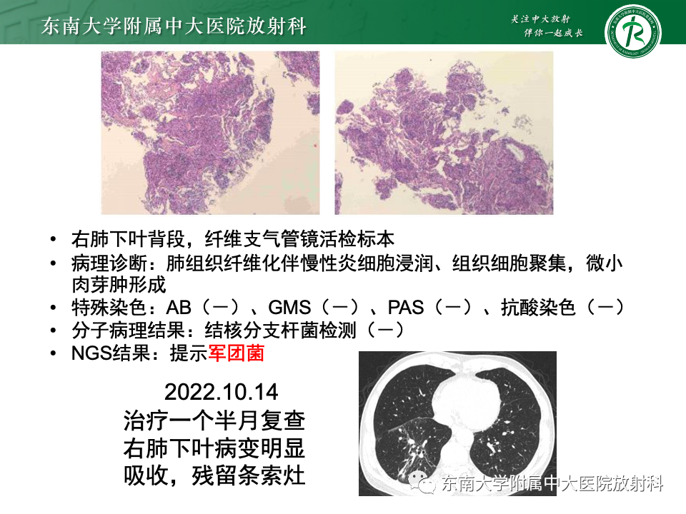 影像PPT - 【PPT】肺炎型黏液腺癌的CT表现-23