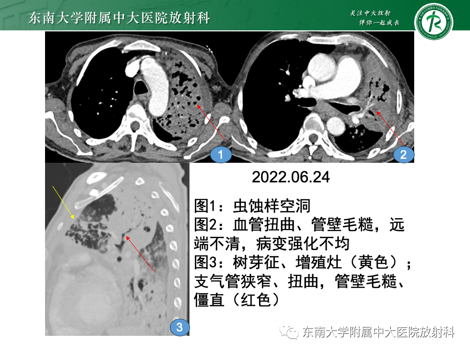 影像PPT - 【PPT】肺炎型黏液腺癌的CT表现-27