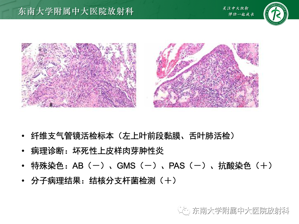 影像PPT - 【PPT】肺炎型黏液腺癌的CT表现-28