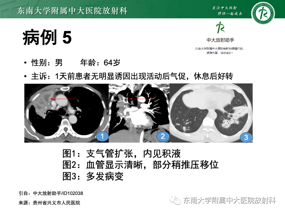 影像PPT - 【PPT】肺炎型黏液腺癌的CT表现-31