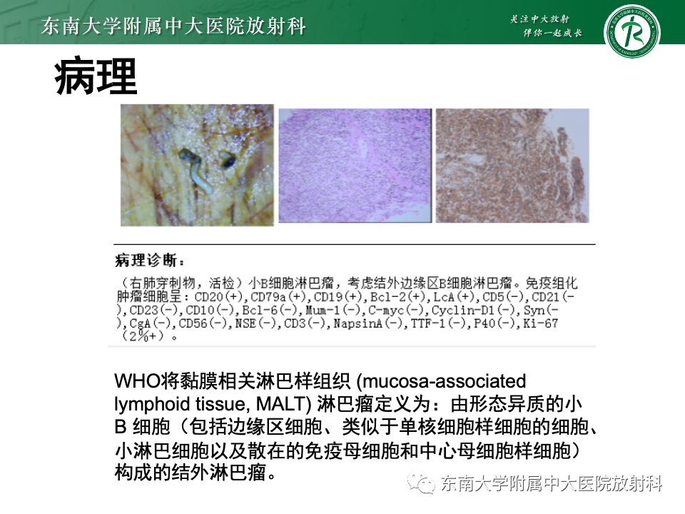 影像PPT - 【PPT】肺炎型黏液腺癌的CT表现-32