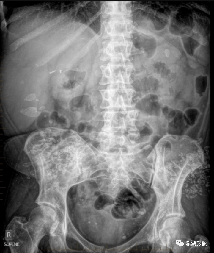 影像PPT - 臀部注射部位肉芽肿-3