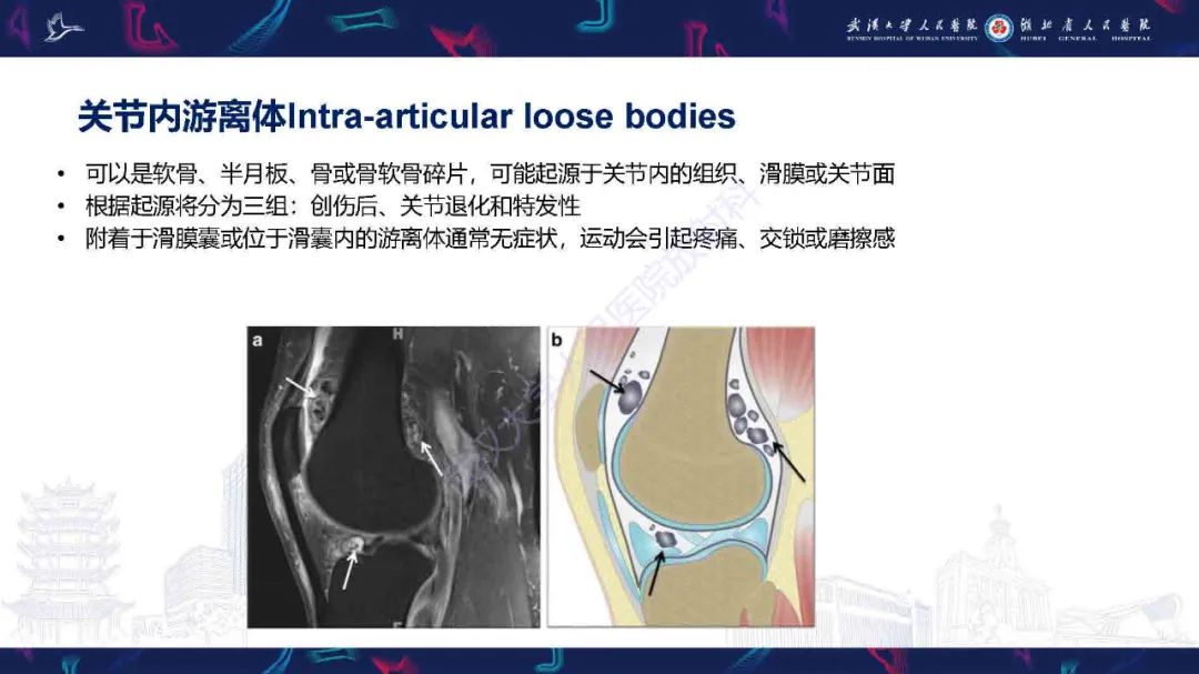影像PPT - 【PPT】膝关节T2WI低信号病变影像诊断-5