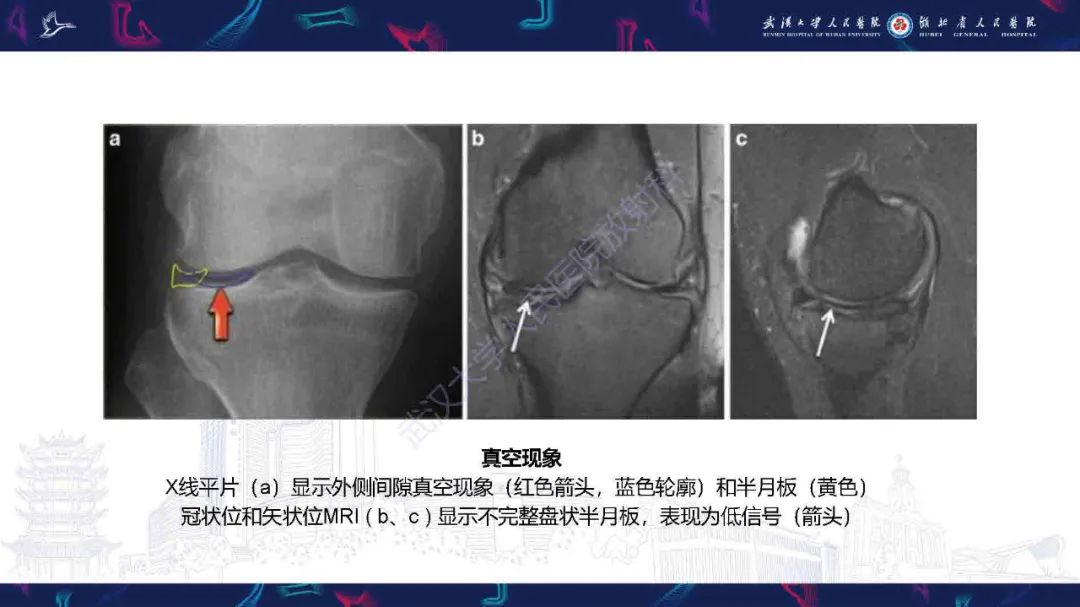 影像PPT - 【PPT】膝关节T2WI低信号病变影像诊断-4