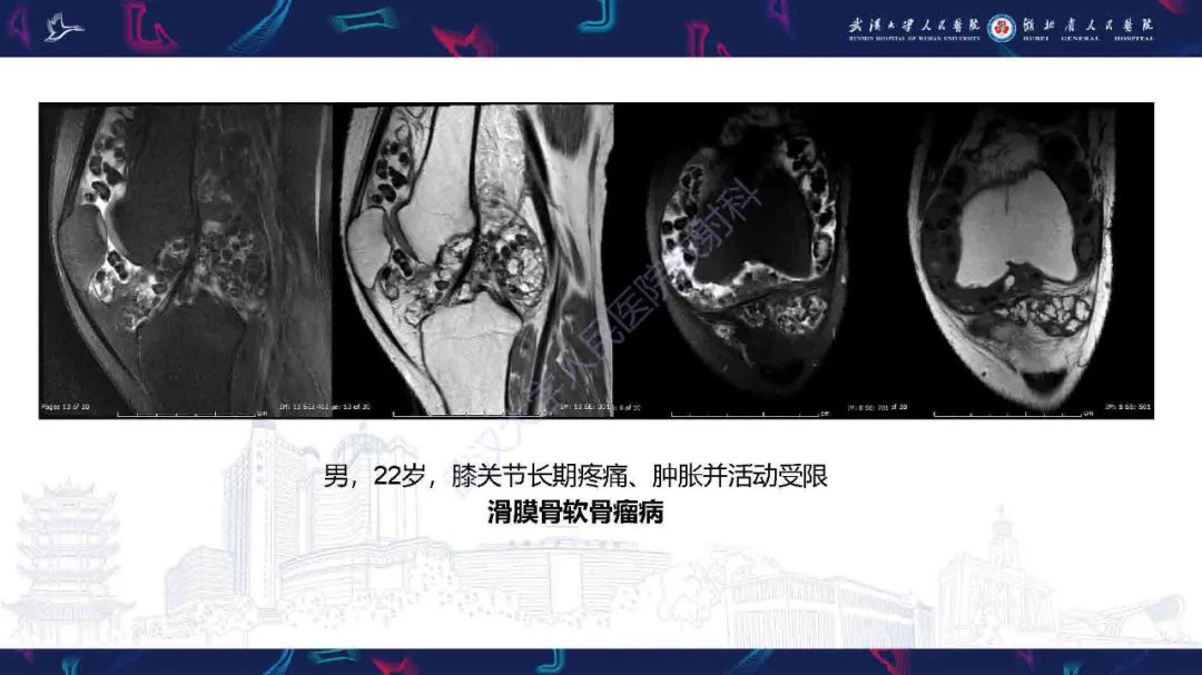 影像PPT - 【PPT】膝关节T2WI低信号病变影像诊断-7