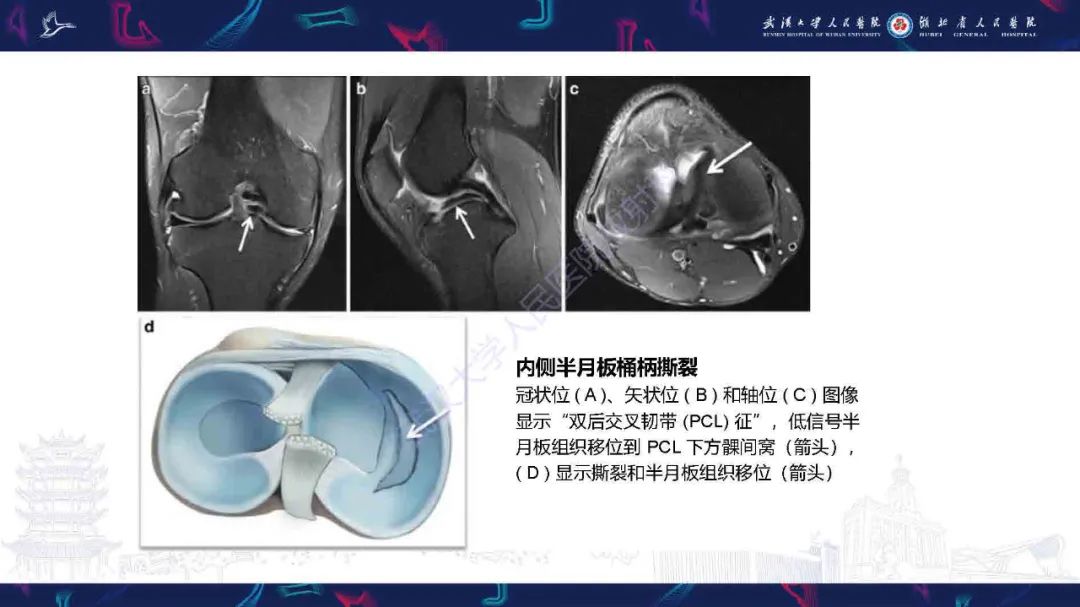 影像PPT - 【PPT】膝关节T2WI低信号病变影像诊断-9